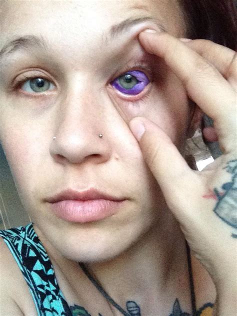 Woman Who Went Blind After Eyeballs Were。